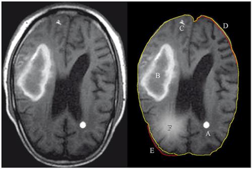 کاهش زمان جراحی بیماران مبتلا به سکته مغزی با کمک نسل جدید سی تی اسکن