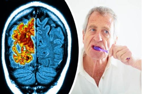 تایید ارتباط مبتلا شدن به آلزایمر با باکتری های دهان