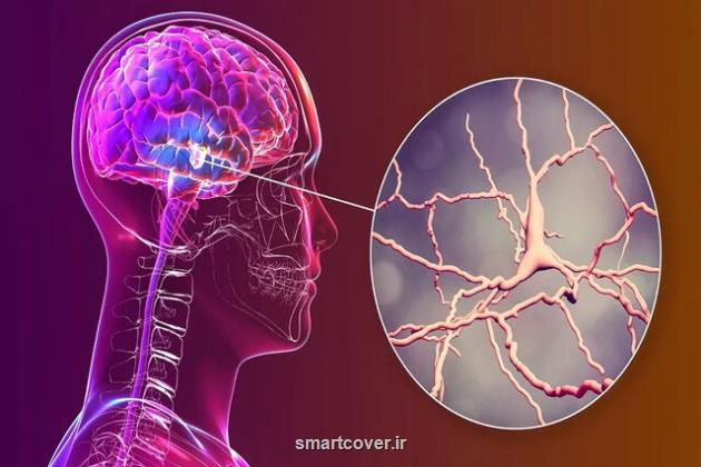 درمان پارکینسون بوسیله سلول های عصبی آزمایشگاهی