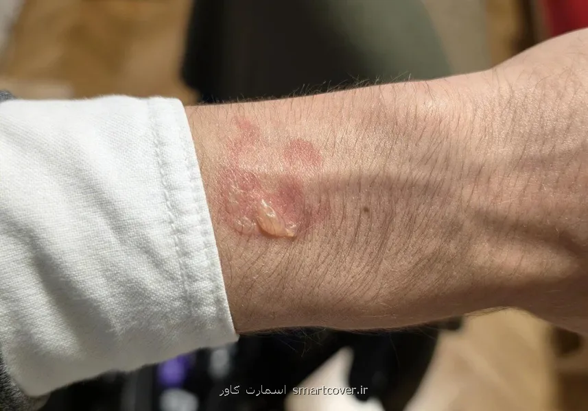 گزارش لطمه پوستی بعد از استفاده شبانه از ساعت گلکسی واچ 5 پروی سامسونگ