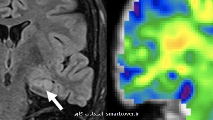 تشخیص صرع با استفاده از روش الاستوگرافی تشدید مغناطیسی