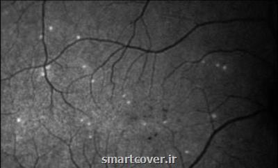 هوش مصنوعی بیماری چشمی را پیشبینی می كند